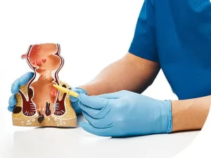 لیزر شقاق مقعدی