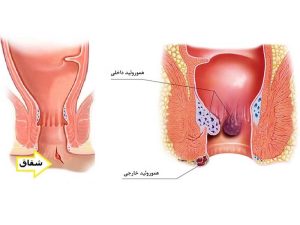 تفاوت آبسه مقعدی و هموروئید