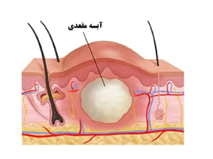 علائم کیست مویی