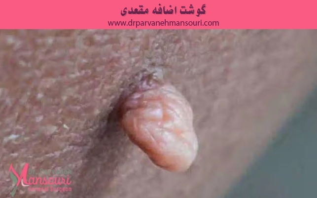 برای گوشت اضافه مقعدی به چه دکتری مراجعه کنیم؟