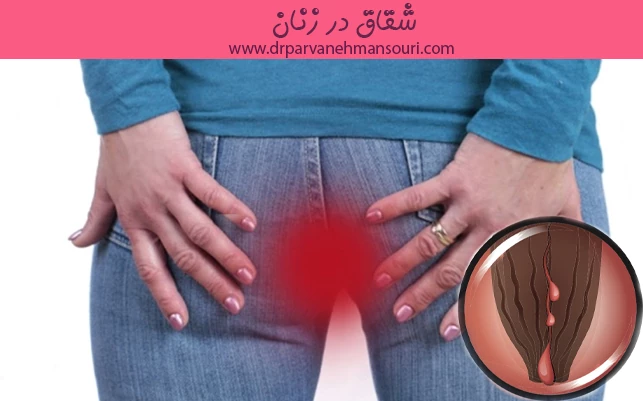 شقاق در زنان