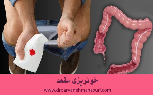 خونریزی مقعد