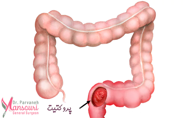 علائم شایع پروکتیت