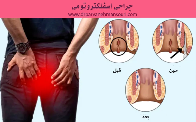 جراحی اسفنکتروتومی