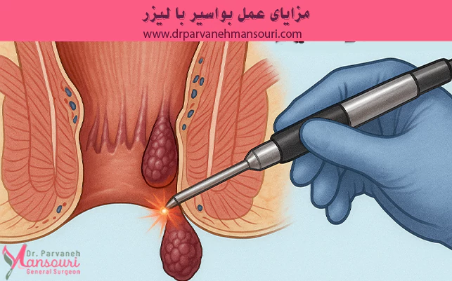 مزایای عمل بواسیر با لیزر