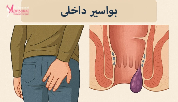 بواسیر داخلی بواسیر داخلی