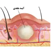 علائم کیست مویی