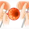 عمل اسفنکتروتومی